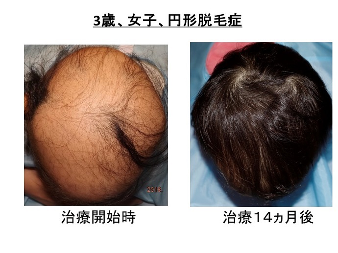 円形脱毛症　病院